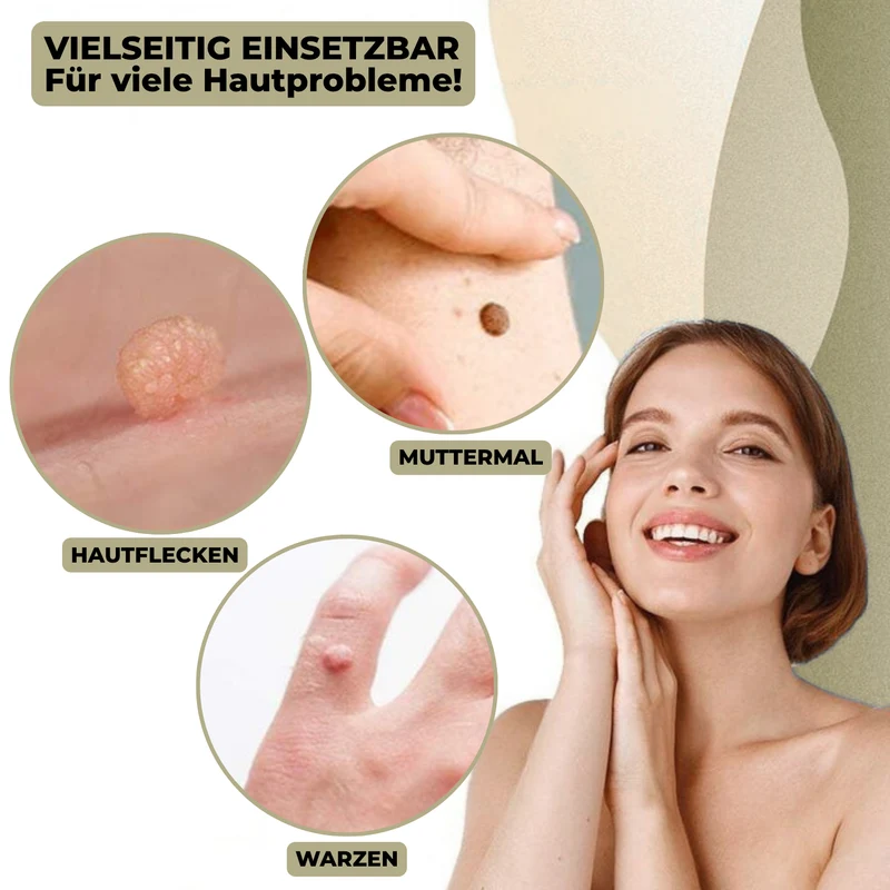 DermaLinx Rimuovi Verruche | Rimozione Indolore di Verruche e Nei | Per Casa | Senza Chirurgia