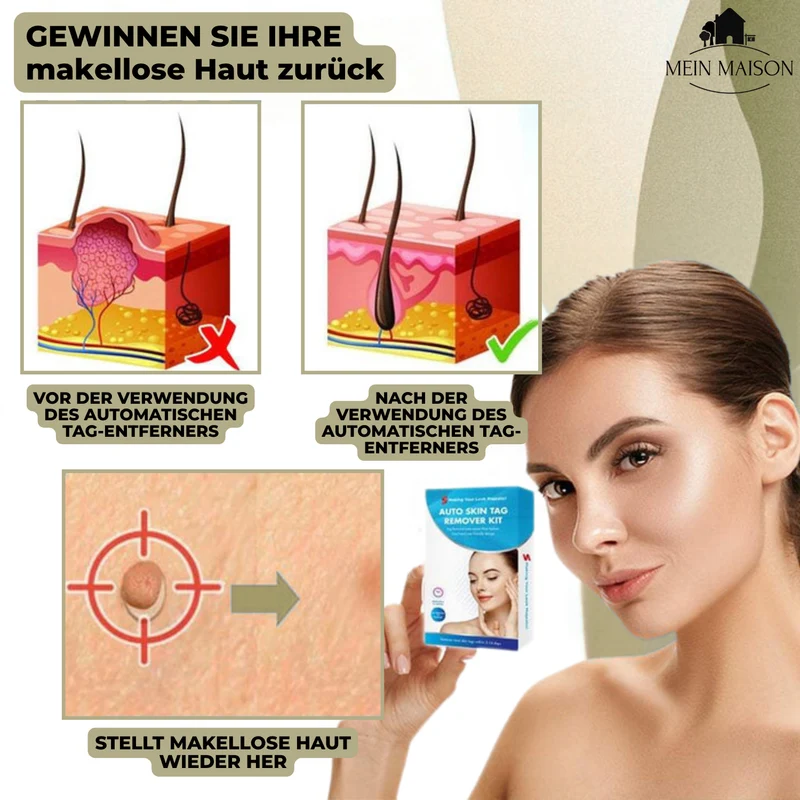 DermaLinx Rimuovi Verruche | Rimozione Indolore di Verruche e Nei | Per Casa | Senza Chirurgia